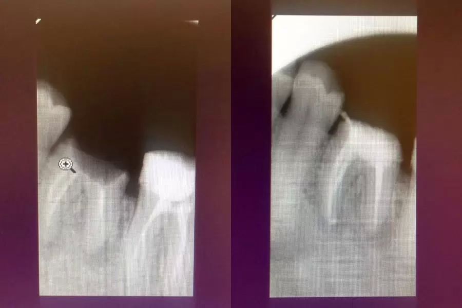 endodoncie 3