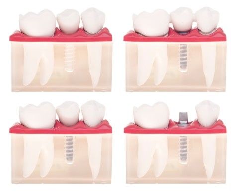 sante implantaty2