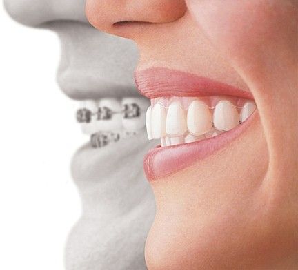 invisalign 4