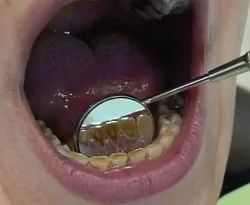 dentalni hygiena 2a