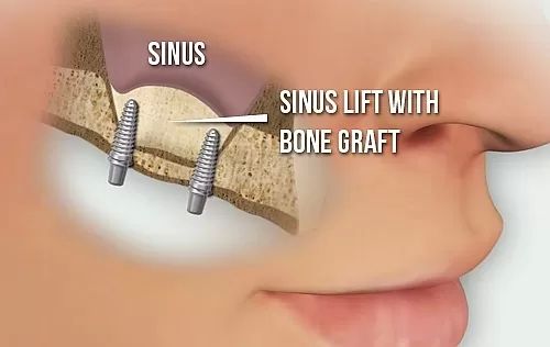sinus lift2