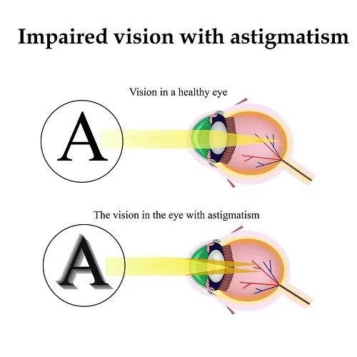 astigmatismus