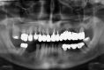 PŠTROSSOVA Medical Centrum - Pacient ročník 1955, přišel se selhaným pohyblivým mostem v horní čelisti, práci měl od předešlého zubního lékaře necelé čtyři roky

Řešení: extrakce zubů 14 až 27, dočasné snímací řešení a pak implantace a fixní most na pěti implantátech a doléčení zubů 15 a 16