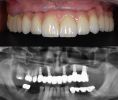 Zubní miniimplantáty - Pacient ročník 1955, přišel se selhaným pohyblivým mostem v horní čelisti, práci měl od předešlého zubního lékaře necelé čtyři roky

Řešení: extrakce zubů 14 až 27, dočasné snímací řešení a pak implantace a fixní most na pěti implantátech a doléčení zubů 15 a 16