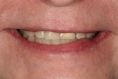 Bělení zubů - fotka před - DentEye - zubní a oční ambulance