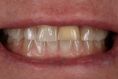 Bělení zubů - fotka před - DentEye - zubní a oční ambulance