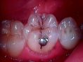 Zubní výplně (záchovná stomatologie) - fotka před - DentEye - zubní a oční ambulance