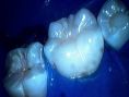 Zubní výplně (záchovná stomatologie) - fotka před