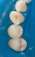 Zubní výplně (záchovná stomatologie) - Fotokompozitní dostavby při ztrátě výšky skusu. V naší klinice řešíme i komplexní případy ztráty výšky skusu. Dle rozsahu a příčiny této ztráty volíme různé postupy a materiály, které však vždy vedou ke stejnému výsledku - obnově tvaru i funkce zubů a navrácení výšky skusu. Zde zachycen stav před a po zhotovení přímých dostaveb z fotokompozitu v dolní čelisti. Na prostřední fotce je dobře viditelný rozsah defektu u prvního zubu(špičáku) a další 2 zuby(premoláry) těsně po zhotovení dostaveb.