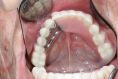 DentEye - zubní a oční ambulance - Zavedení a vylepšení retence  snímatelné náhrady. Terapie s Keratory