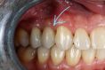 DentEye - zubní a oční ambulance - Komplexní kazuistika se spoluprací implantologie, protetiky a ortodontické léčby