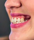 Zubní implantáty - Vizualizace Vašeho nového úsměvu - abychom Vám mohli změnu Vašeho úsměvu dopředu ukázat, máme na klinice malé fotostudio, kde Vás vyfotíme, a do několika minut Vám pomocí speciálního počítačového programu navrhneme nový úsměv.
