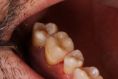 Keramické korunky a můstky - fotka před - AES clinic - stomatologie & zubní hygiena