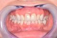 Keramické korunky a můstky - fotka před - AES clinic - stomatologie & zubní hygiena