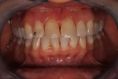 Keramické fazety - fotka před - AES clinic - stomatologie & zubní hygiena