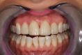 Keramické fazety - fotka před - AES clinic - stomatologie & zubní hygiena