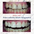 Zubní výplně (záchovná stomatologie) - fotka před - Dr. Sergiy Syergyeyev
