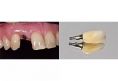 RB Dent - centrum komplexní stomatologie - Fotografie před a po vložení zubního implantátu + detail použitého zubního implantátu. 
Z archivu RB dent - MUDr. Richard Benko