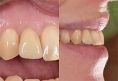 Zubní implantáty - Fotografie před a po vložení zubního implantátu + detail použitého zubního implantátu. 
Z archivu RB dent - MUDr. Richard Benko