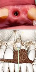 RB Dent - centrum komplexní stomatologie - Náhrada zubu pomocí zubního implantátu, před a po implantaci zubní náhrady. 
Archiv: RB dent Liberec - MUDr. Richard Benko