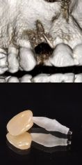 Zubní implantáty - Náhrada dvojky nahoře, zubní implantát, stav před a po + detail náhrady. 
Archiv: RB dent - MUDr. Richard Benko
