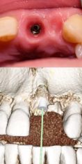 Zubní implantáty - Náhrada zubu pomocí zubního implantátu, před a po implantaci zubní náhrady. 
Archiv: RB dent Liberec - MUDr. Richard Benko