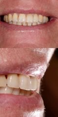 MUDr. Richard Benko - Náhrada zubu pomocí zubního implantátu, před a po implantaci zubní náhrady. 
Archiv: RB dent Liberec - MUDr. Richard Benko