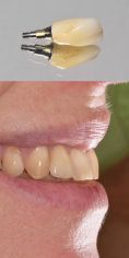 Zubní implantáty - Fotografie před a po vložení zubního implantátu + detail použitého zubního implantátu. Z archivu RB dent - MUDr. Richard Benko