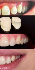 Zubní implantáty - fotka před - MUDr. Richard Benko