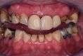 Zubní implantáty - fotka před - AES clinic - stomatologie & zubní hygiena