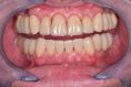 Zubní implantáty - fotka před - AES clinic - stomatologie & zubní hygiena