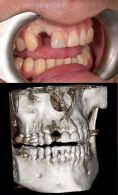 Zubní implantáty - MUDr. Richard Benko