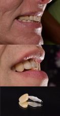 Zubní implantáty - MUDr. Richard Benko