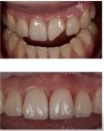 Zubní výplně (záchovná stomatologie) - fotka před - MUDr. Richard Benko