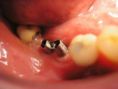 Zubní implantáty - fotka před - MUDr.  Jan Paroulek CSc.