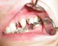 Zubní implantáty - fotka před - MUDr.  Jan Paroulek CSc.
