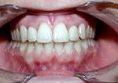 Zubní implantáty - fotka před - DENTALCLINIC - soukromé stomatologické centrum MUDr. Ivo Marek