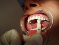 Bělení zubů - fotka před - Centrum estetické stomatologie ARIES s.r.o.