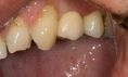 Zubní implantáty - fotka před - MUDr. Martin Kittler