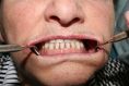 Zubní implantáty - fotka před - MUDr. Miroslav Fiala