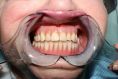 Zubní implantáty - fotka před - MUDr. Miroslav Fiala