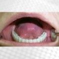 Zubní implantáty - fotka před - Stomatologické centrum ALDENTA