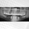 Zubní implantáty - fotka před - MUDr. Jitka Kovářová