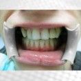 Zubní implantáty - fotka před - MUDr. Jitka Kovářová