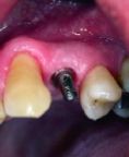 Zubní implantáty - fotka před - Asklepion - Institut klinické a estetické medicíny - STOMATOLOGIE