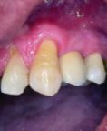 Zubní implantáty - fotka před - Asklepion - Institut klinické a estetické medicíny - STOMATOLOGIE
