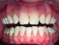 Bělení zubů - fotka před - Asklepion - Institut klinické a estetické medicíny - STOMATOLOGIE