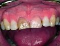 Bělení zubů - fotka před - Asklepion - Institut klinické a estetické medicíny - STOMATOLOGIE
