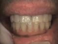 Zubní implantáty - fotka před - ALFADENT - dentální klinika Praha 5