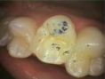 Zubní výplně (záchovná stomatologie) - fotka před - ALFADENT - dentální klinika Praha 5
